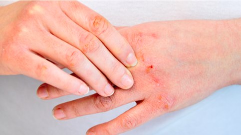 What is Chickenpox?How Home healthcare helps in prevention.