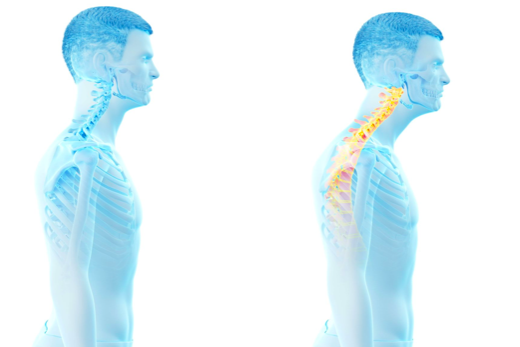 What is Forward Head Posture?.How it can be prevented.